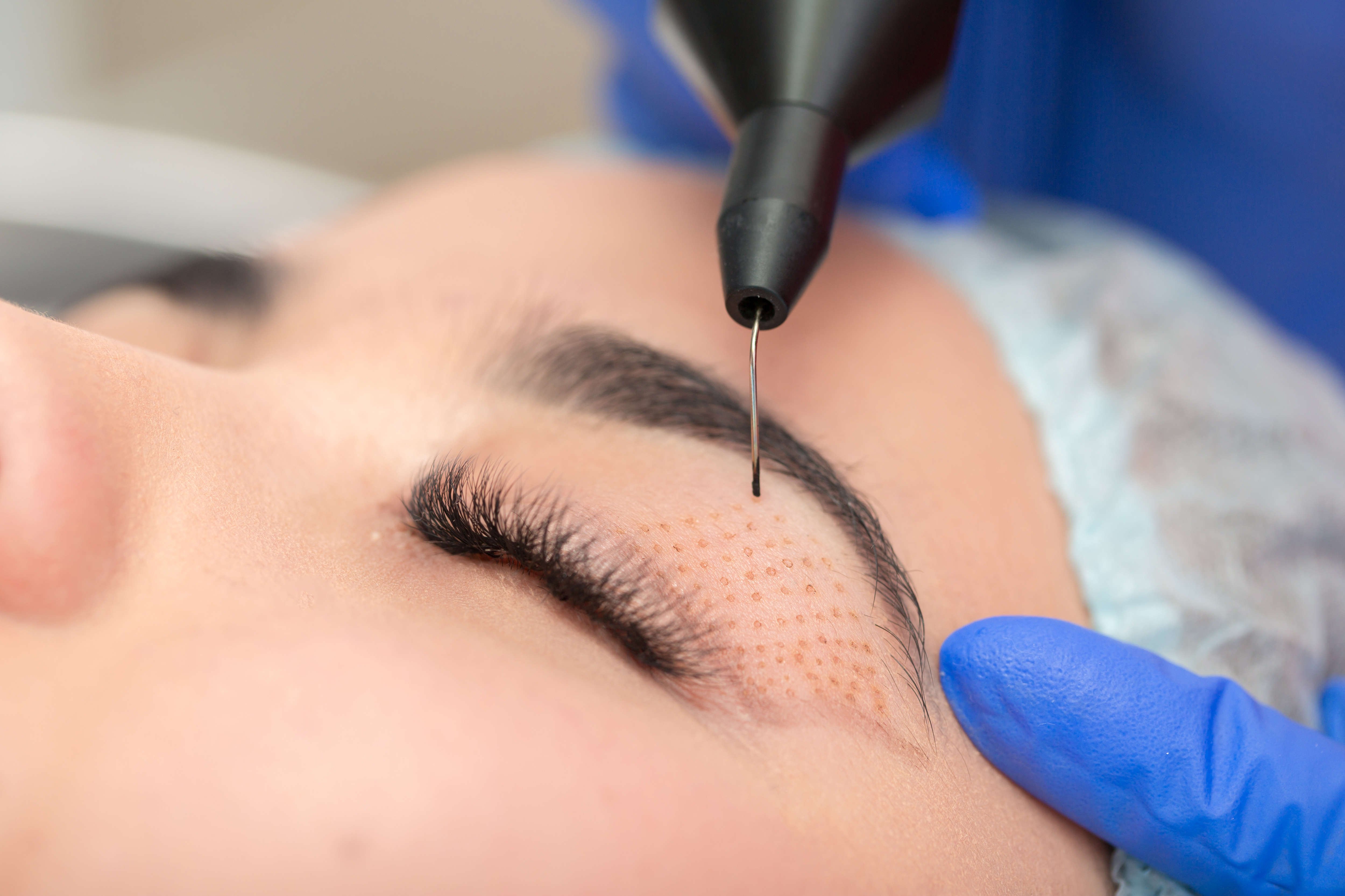 Plasma Pen Faltenbehandlung